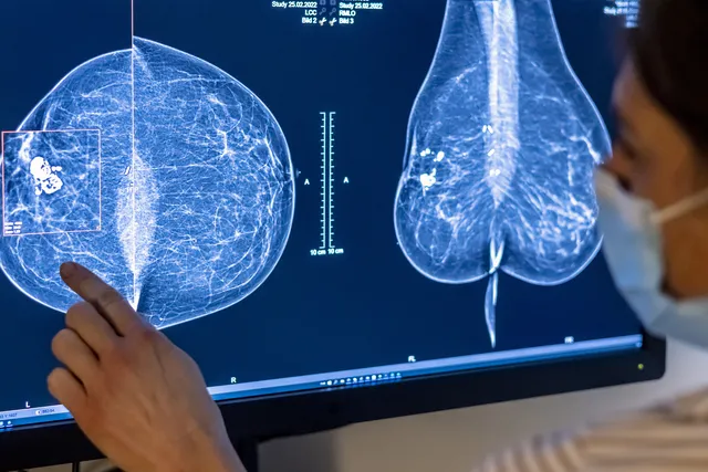 Google поможет обнаружить рак груди с помощью ИИ